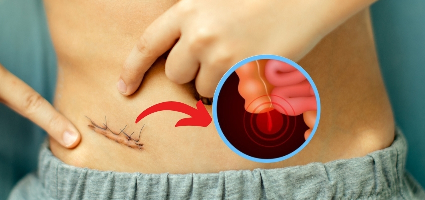 Appendix Surgery