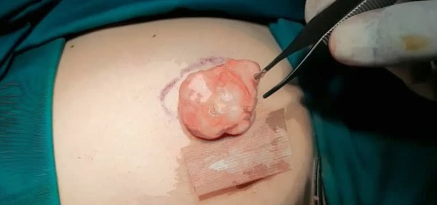Breast Lump Surgery