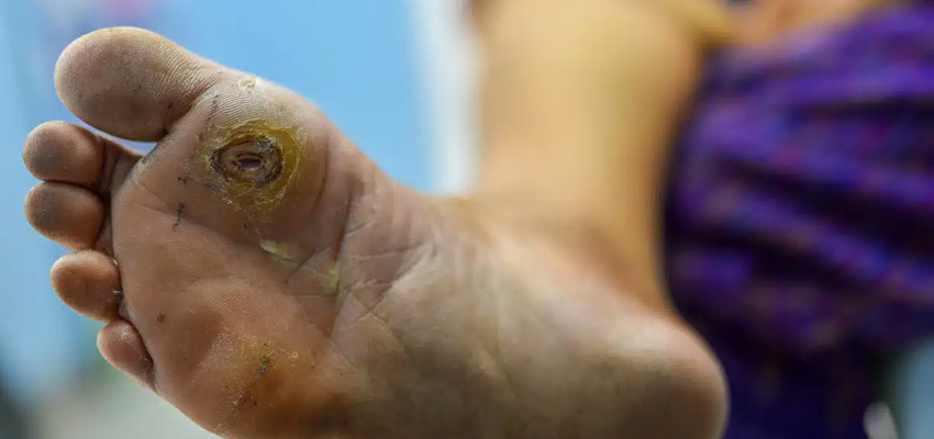 Diabetic Foot Treatment