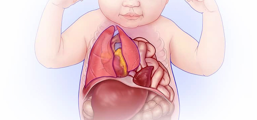 Diaphragmatic Hernia Repair