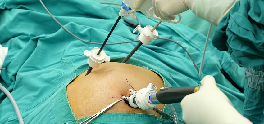 Gall Bladder Stone Surgery