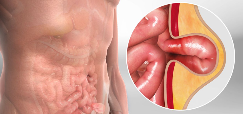 Hernia Surgery
