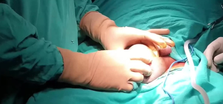Hydrocele Surgery