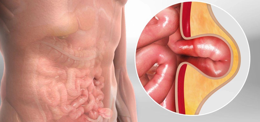 Laproscopic Hiatus Hernia