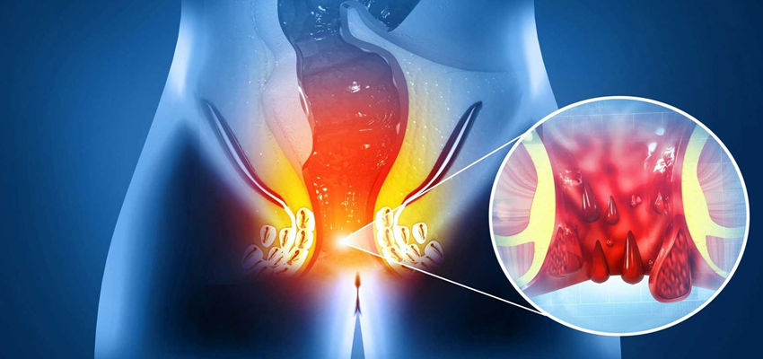 Laser Fissure Treatment