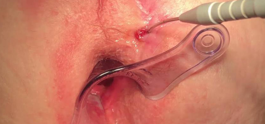 Laser Fistula Treatment