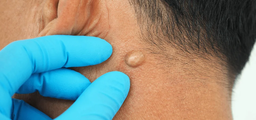 Lipoma Surgery