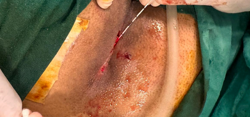Pilonidal Sinus Surgery